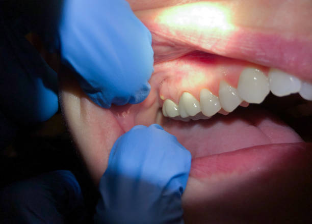 Best Cracked Tooth Emergency Dentist  in Cocoa West, FL